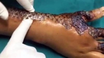 بالفيديو.. كيف تعالج الحروق بقشر السمك؟!