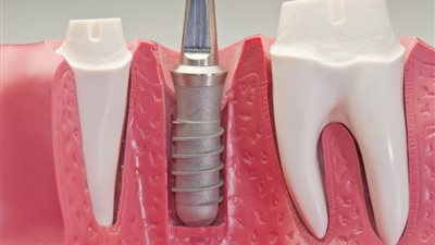 تقنية جديدة لزراعة الأسنان في 9 أسابيع!