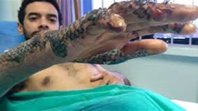 جلد السمك البلطي أحدث وسيلة لعلاج الحروق