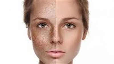 5 وصفات طبيعية للقضاء على «النمش» في أسبوع