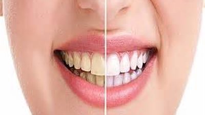 طرق الحصول على أسنان ناصعة البياض