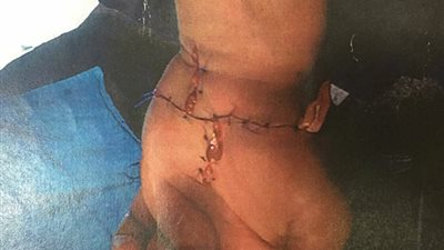 القبض على موظف«الخليجية للتوكيلات» بعد 4 سنوات من بتر ذراع جاره