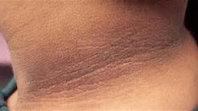 3 وصفات سحرية للتخلص من «سواد الرقبة»