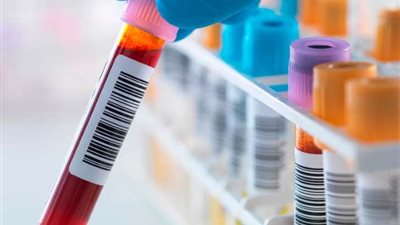 اختبار بسيط للدم يكشف عن مرض الزهايمر قبل ظهور الأعراض