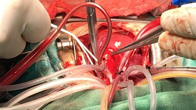 الكشف عن تقنية جديدة بديل لإجراء جراحة الشريان التاجي