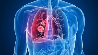 فوائد مُذهلة لهذا المُركب في علاج «سرطان الرئة»