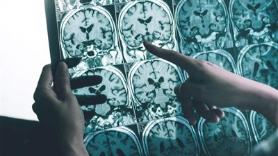 اكتشاف علاج جديد لمرض الزهايمر