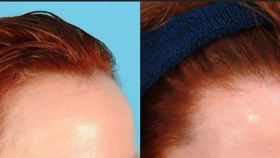 طُرق فعالة لزيادة كثافة الشعر بعد «عملية الزرع» وللقضاء على «الصلع»