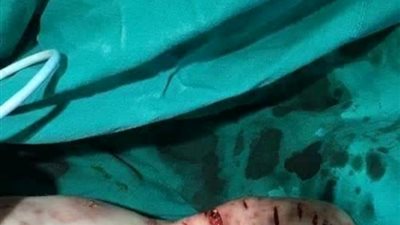 إنقاذ رضيع نهشت الكلاب جسده في القليوبية 