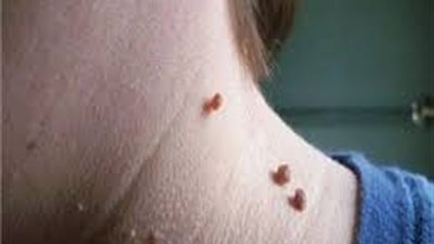 وصفات طبيعية لـ«علاج البثور الجلدية».. تعرف عليها