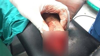 مسجل خطر يقطع يد شاب بطريقة «بشعة» في المعادى.. اعرف التفاصيل 