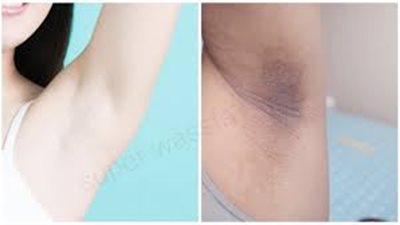 وصفات طبيعية لإزالة السواد من تحت الإبط