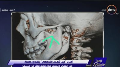 أطباء «عين شمس التخصصي» ينقذون فتاة دخل قلم في عينها.. 