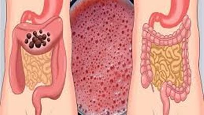 بالفيديو.. طُرق طبيعية لتنظيف «القولون» من السموم 