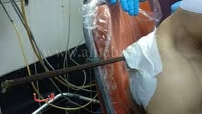 استخراج سيخ حديد اخترق رئة مواطن بمستشفى الطوارئ في جامعة المنصورة