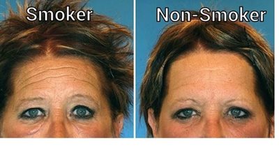 بالصور.. مقارنات بين توائم مدخن وغير مدخن