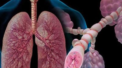 طرح أول دواء مصري لعلاج مرضى الانسداد الرئوي المُزمن