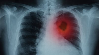 5 أطعمة تقلل من فرص الإصابة بسرطان الرئة.. تعرف عليهم