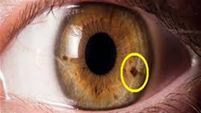 لا تتجاهلها.. علامة في العين تكشف عمر مرضى القلب
