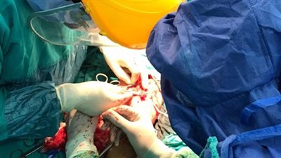 بالصور| «الجيش الأبيض» بطوارئ طنطا الجامعي ينجح في زرع كف شاب بعد بترها