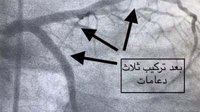 فريق طبي بمستشفى المنصورة ينجح في تركيب 3 دعامات لمريض مسن