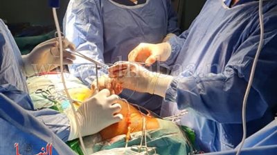 جراحة ناجحة لتغيير صمامات القلب بالمنظار داخل مستشفى المنصورة الدولي