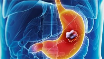 منها حدوث مُشكلة في بلع الطعام.. 