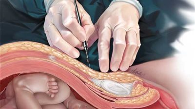 نجاح عملية ولادة قيصرية لأم مصابة بفيروس كورونا في مستشفى المنصورة الدولي