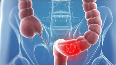 عندك مُشكلة في القولون خلال شهر رمضان؟ إليك هذه النصائح الذهبية