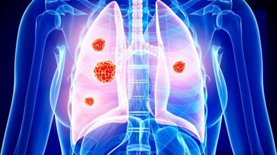 لن تصدق.. وصفة سحرية لتقوية رئتيك في زمن الكورونا