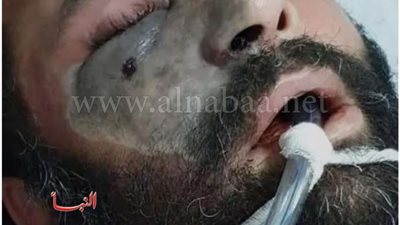 إجراء عاجل من «الصحة» بشأن بروتوكول خوفًا من الفطر الأسود