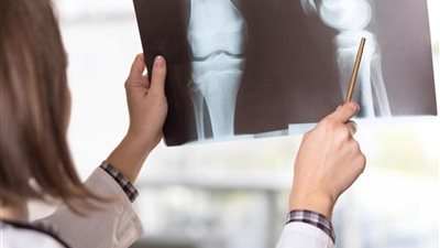 استكمال الكشف المجاني عن أمراض هشاشة العظام بمحافظات المرحلة الأولى للتأمين الصحي الشامل