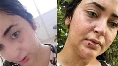 صيدلانية تكشف تفاصيل اعتداء زميلاتها عليها بسبب الحجاب