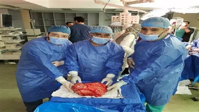 تفاصيل أخطر عملية لاستئصال ورم يزن 18 كجم من شاب بسوهاج الجامعي
