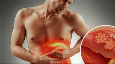 سرطان الكبد.. أهم أعراضه وأسباب الإصابة به وطرق الوقاية منه