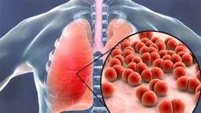  إطلاق برنامج حواري على الإنترنت بمناسبة اليوم العالمي لمكافحة مرض السل
