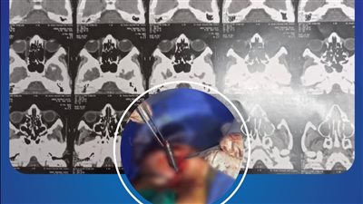 فريق طبي بالزقازيق ينجح في استخراج قلم من عين طفل.. ما الحكاية؟ 