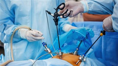 «الإفتاء»: حالة واحدة يجوز فيها إجراء عملية تكميم المعدة