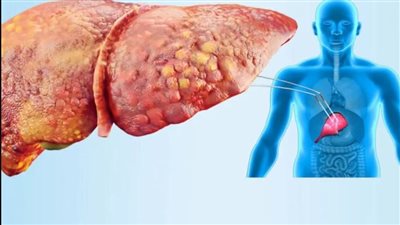 انتبه.. أعراض تخبرك أنك مريض بالتهاب كبدي