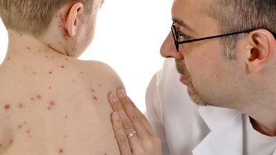 بعد تفشي المرض.. أمريكا تشهد ثالث حالة وفاة بالحصبة