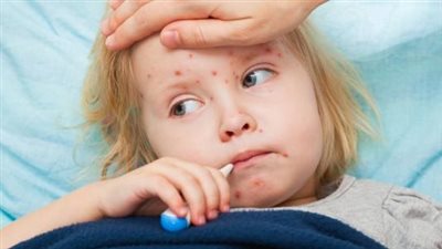 ارتفعت بنسبة 79%.. الصحة العالمية تُحذر من ارتفاع معدلات الاصابة بالحصبة