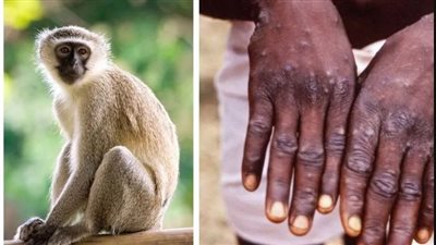 جدري القرود ينتشر في 12 دولة.. والصحة العالمية تبحث تصعيد الأزمة إلى حالة طوارئ صحية