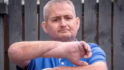 إجراء أول عملية زرع يد في العالم لرجل بريطاني