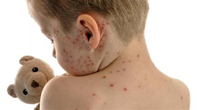  الموافقة على لقاح الحصبة والنكاف للوقاية ابتداءًا من عمر 12 شهرًا فأكثر