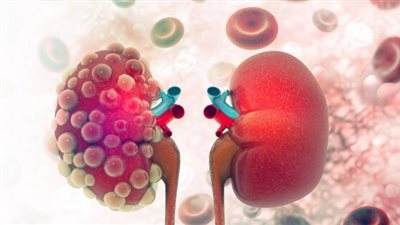 منها وجود دم في البول.. علامات تشير إلى الإصابة بمرض تليف الكلى