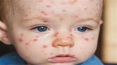 وزارة الصحة تعلن عن حالة إصابة جديدة بفيروس جدري القردة