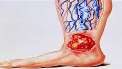 عوامل زيادة خطر الإصابة بقرحة الساق الوريدية