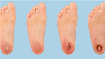 ما أهمية علاج قرحة القدم السكري؟.. استشاري يجيب