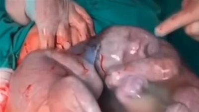 حالة ولادة نادرة.. توأم يخرج بكيس الجنين من رحم أمه!