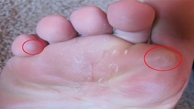 أستاذ جراحة: علاج القدم السكري يحتاج برنامجا طبيا دقيقا